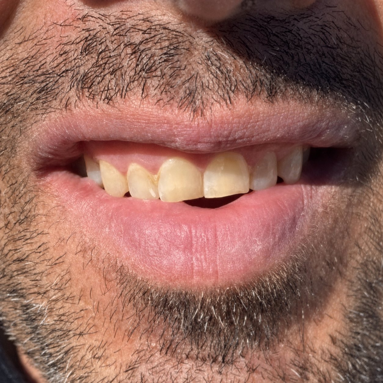 Same lower lip 48 hours later, actively healing with scab formation and reduced redness after four daily applications of Labisan Protective Lip Balm, male with beard