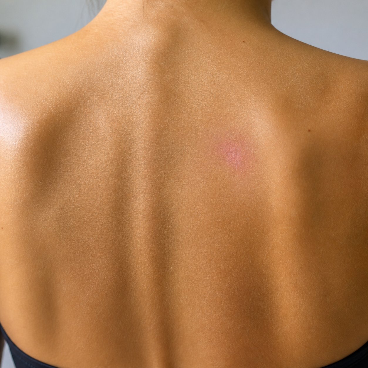 Same upper back 120 hours into Labisan dual protocol with crust shed and faint pink residual mark on the shoulder blade