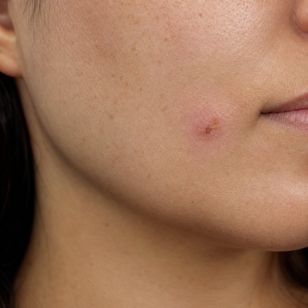 Same cheek 48 hours into Labisan dual protocol with smaller crusted lesion and reduced surrounding redness