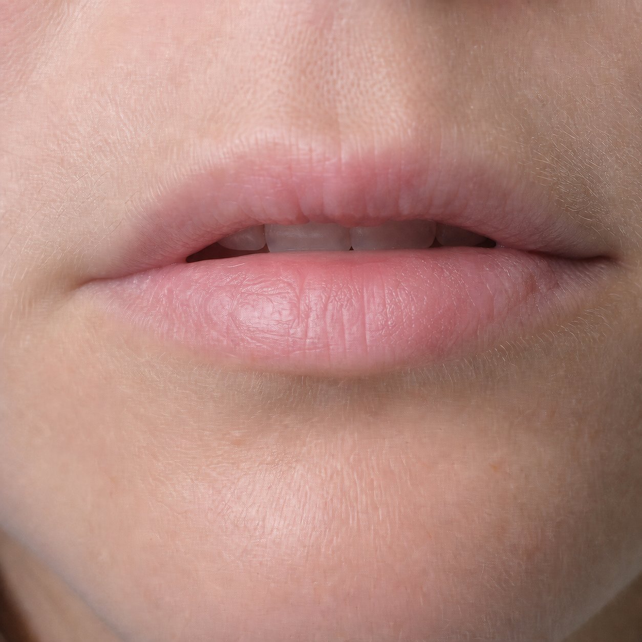 Same fair-skinned woman's lower lip 48 hours later, actively healing at 48 hours on the four-applications-daily Labisan Protective Lip Balm protocol