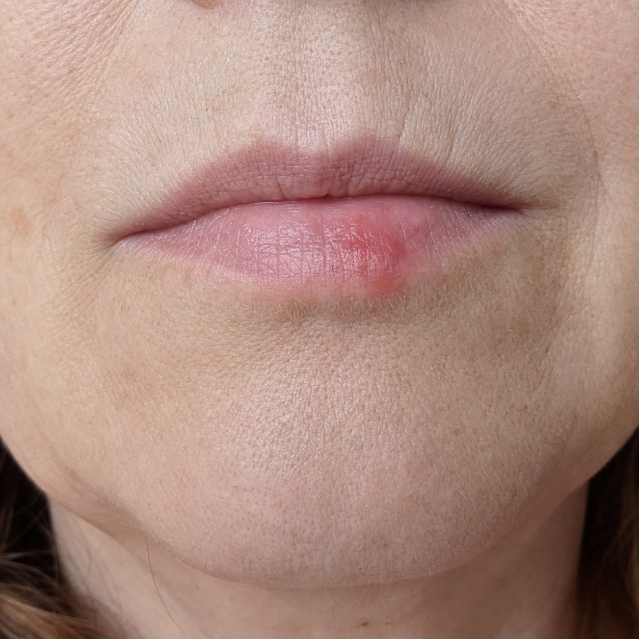 Early herpes prodrome with localised redness and inflammation on a mature woman's lower lip on day zero, no vesicles formed yet