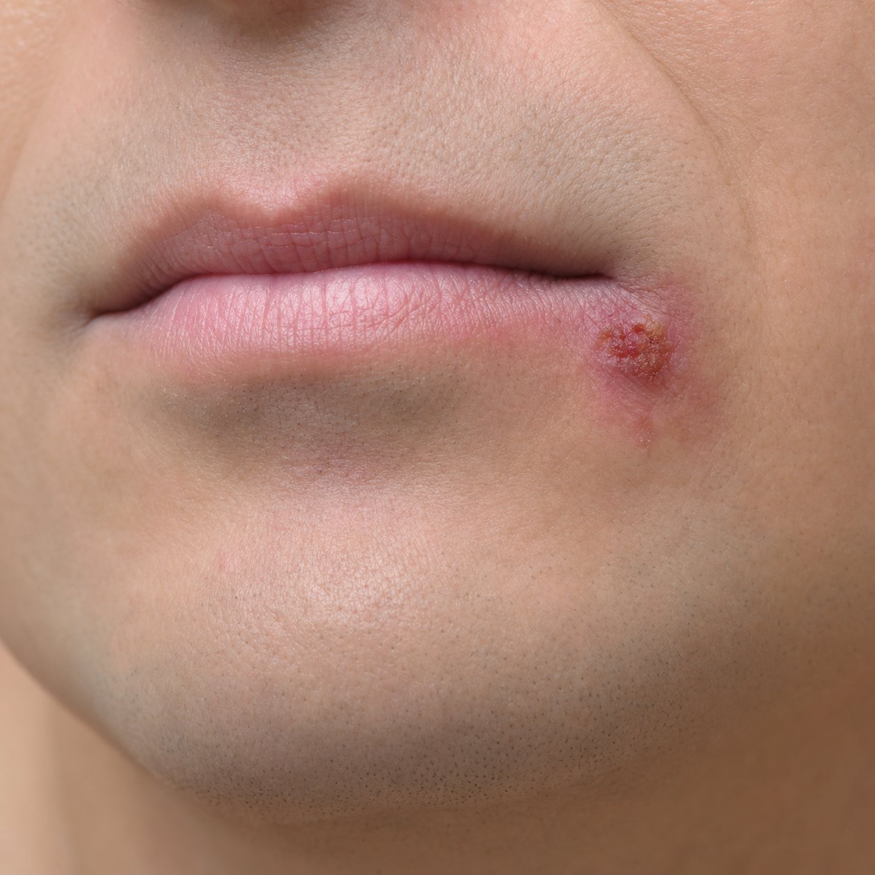 Cold sore lesion at the corner of a clean-shaven man's mouth on day zero with crusting and redness