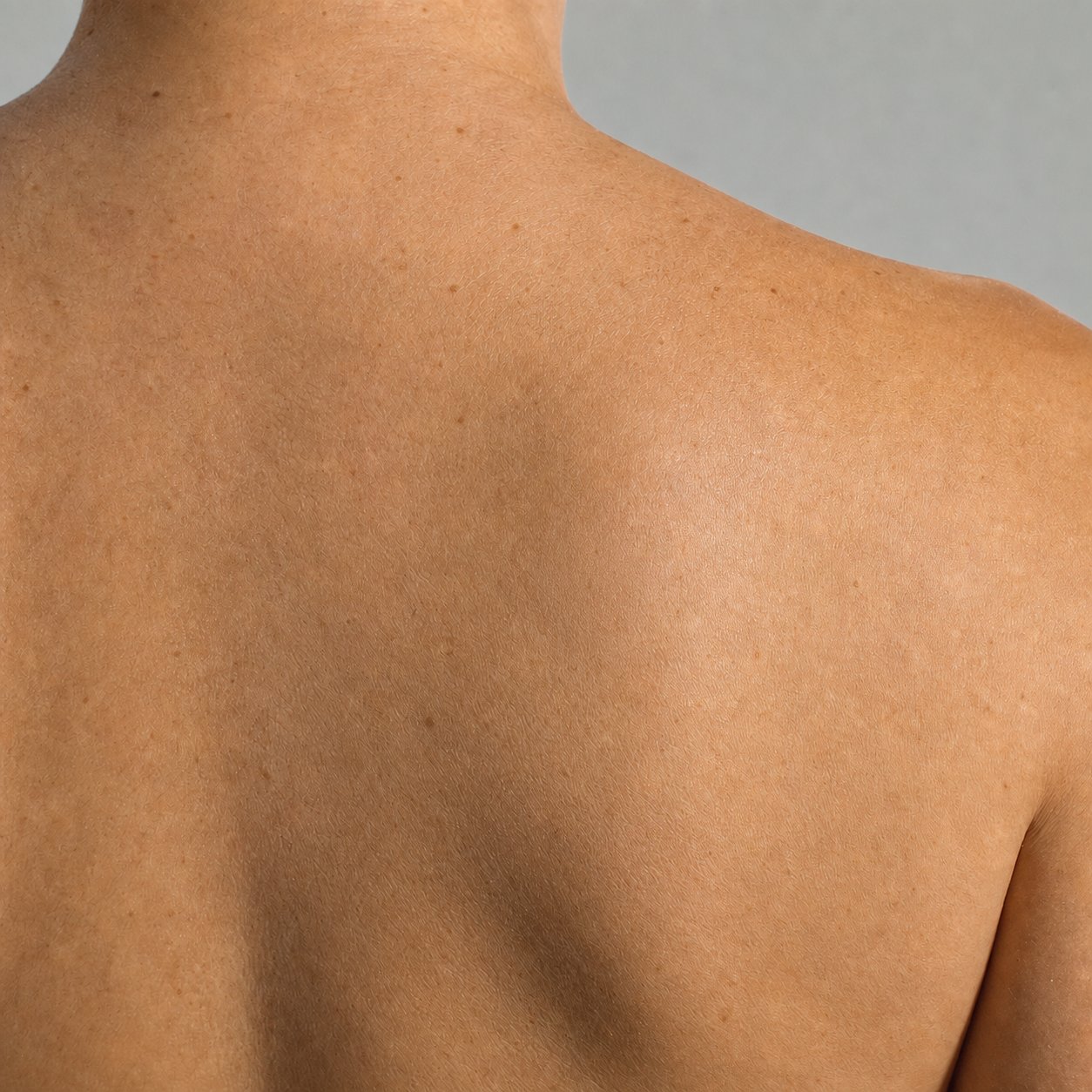 Same upper back area 48 hours later, vesicle cluster actively healing on the Labisan Protective topical protocol